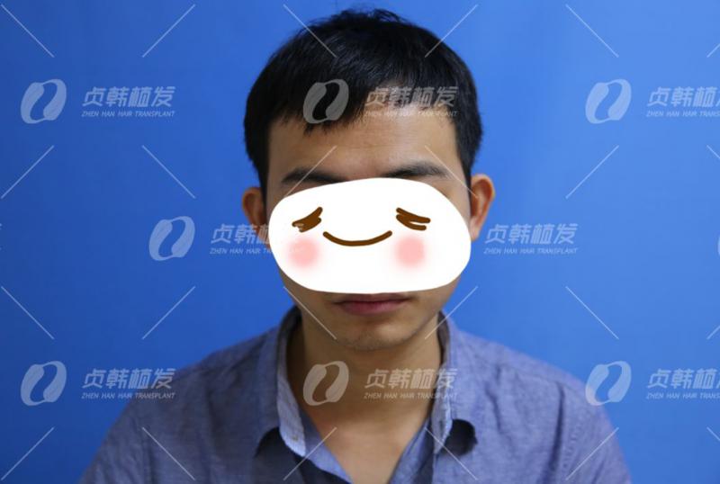 植发案例21岁大学生偷偷植发不让同学知道