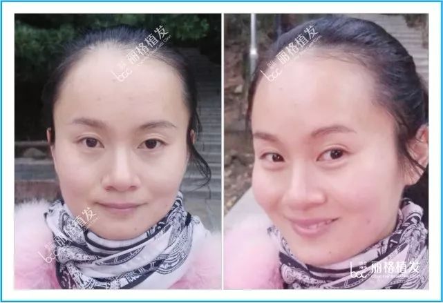 产后脱发的她发际线调整植发变成了这样