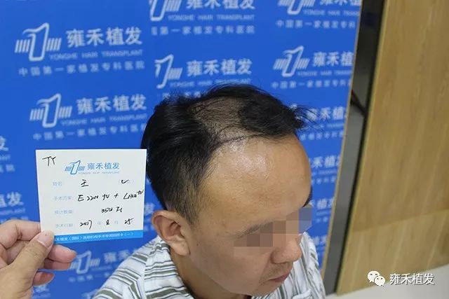 头顶秃发治疗雍禾植发3910单位半年变浓密笑出来