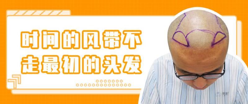 93年小伙植发3500毛囊单位重获新生