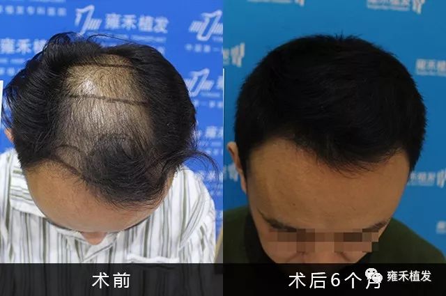 头顶秃发植发3910单位半年变浓密笑出来