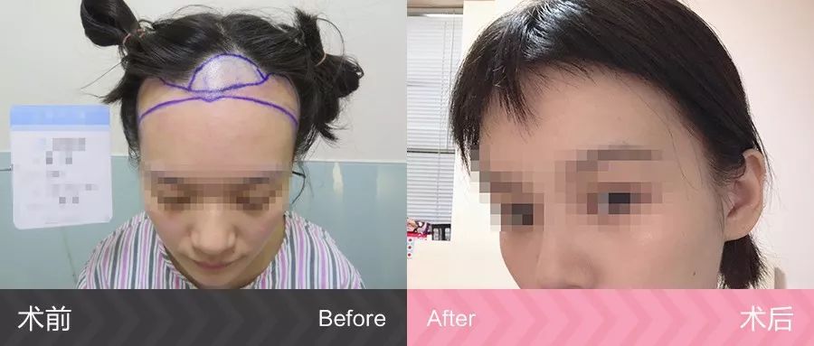 发友豆豆发际线种植跑了三趟才终于做了植发