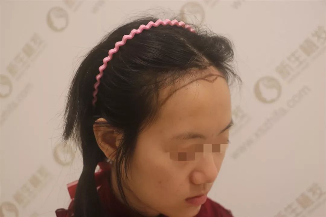女孩发际线植发1700毛囊单位270天后的效果