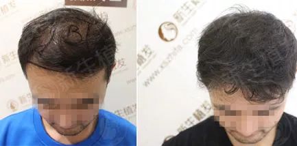 遗传性脱发8个月植发治愈过程前后简直年轻了20岁