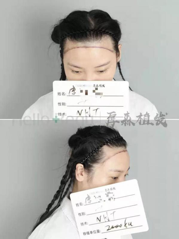 发际线案例植发2000单位种植我植得更美