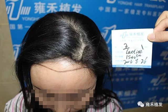 美女种植美人尖按说用FUE可她非要用加密技术