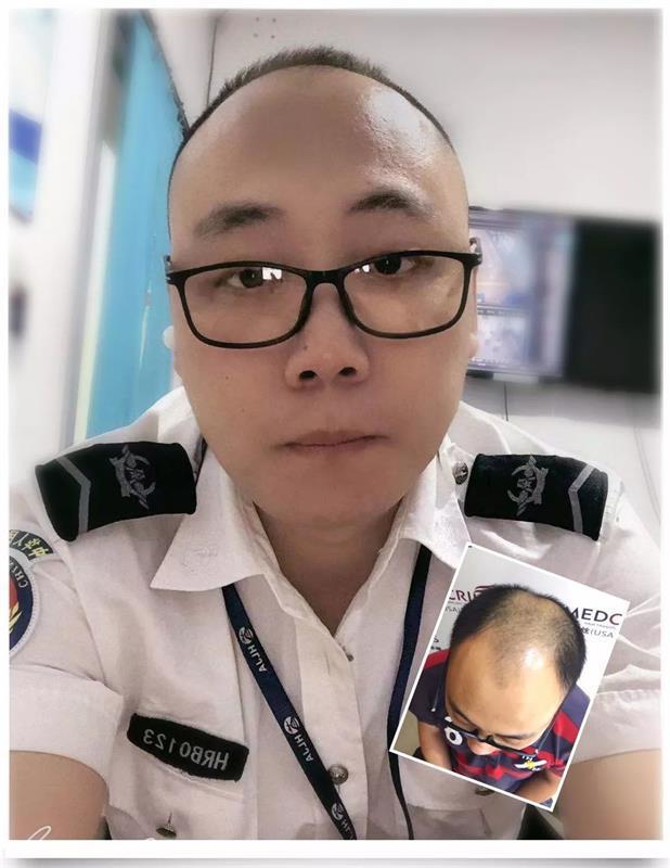 年纪轻轻就脱发80后男子美利丝植发效果