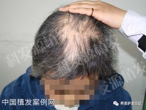 疤痕种植手术真的有效果吗？金女士修复案例