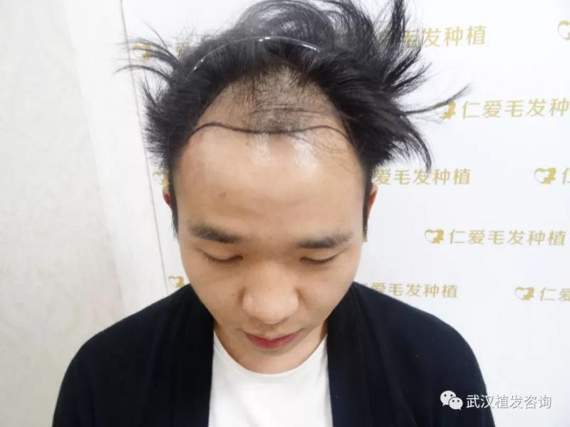 我不植发真香