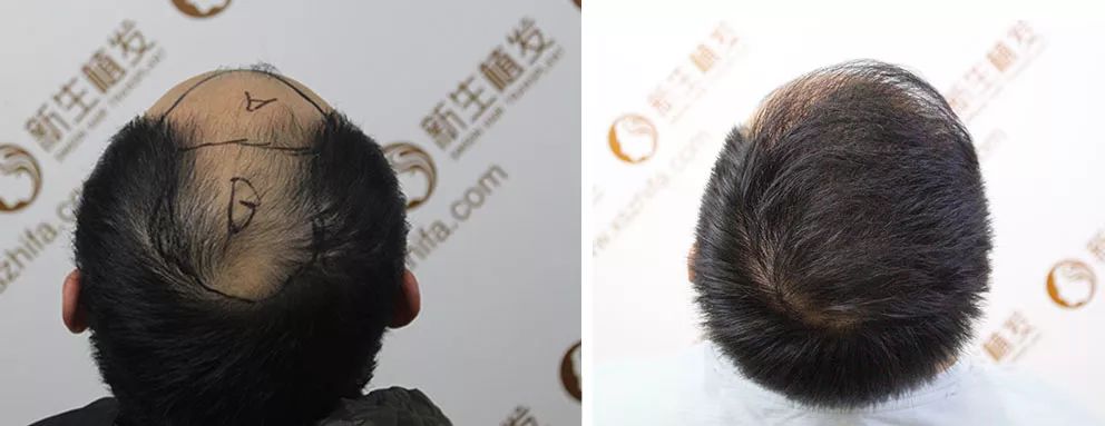 王先生秃顶植发4500单位术后效果这么好！