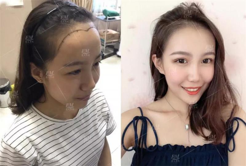 美人尖种植真人案例魅力爆加分