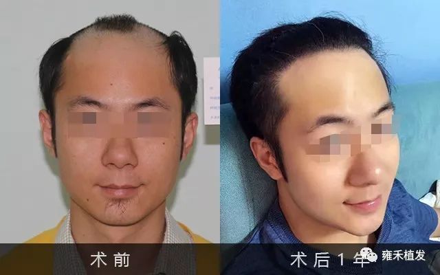6级脱发植发4015单位1年后头发浓密帅气当婚庆主持