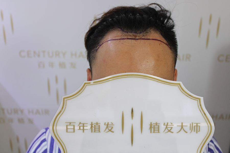 头发种植2400毛囊单位后完美填补蚕食额角