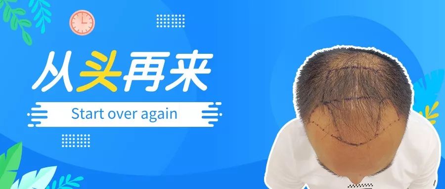 兵哥哥植发3500单位后蜕变帅哥哥