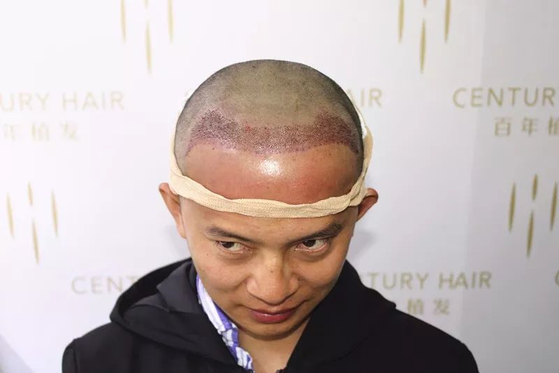 微针种植2000毛囊单位发际线焕发青春好颜值