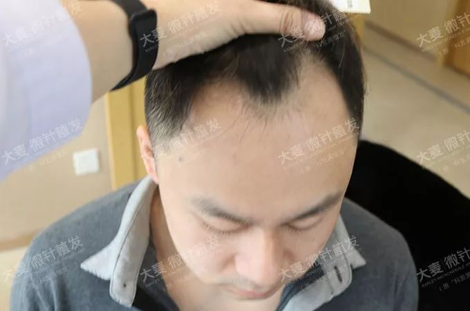 健身教练植发2000单位术后6个月重回帅气猛男！