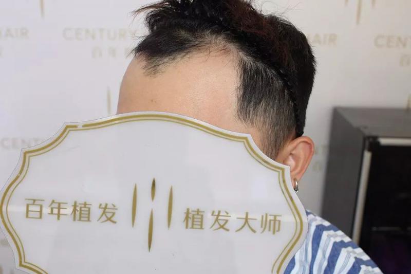 额角种植2500单位彻底摆脱M秃种植密度如何算？