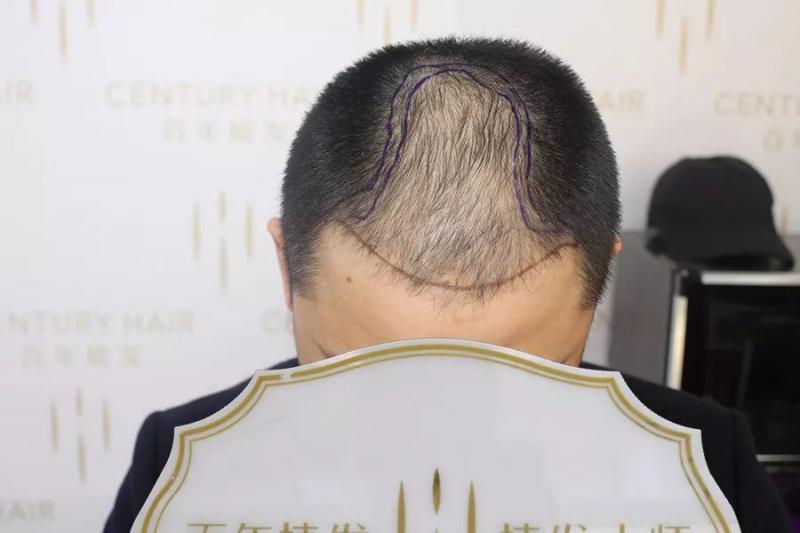 不顾老婆阻拦他坚持植发结果令人大感意外