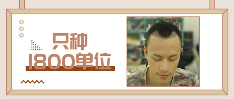 用药稳定后他只植发1800单位修复了额角！