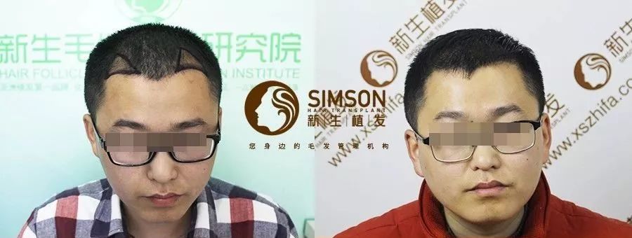植发后四年效果怎么样？