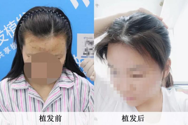 美女好头发植发2300单位效果好到爆