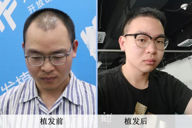 没钱也可以植发吗？有机会免费植发的