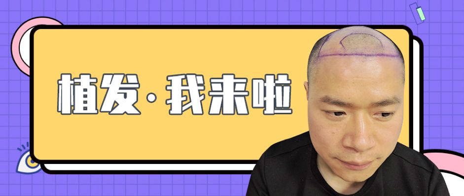 发友说我没想到自己植发后效果会这么好