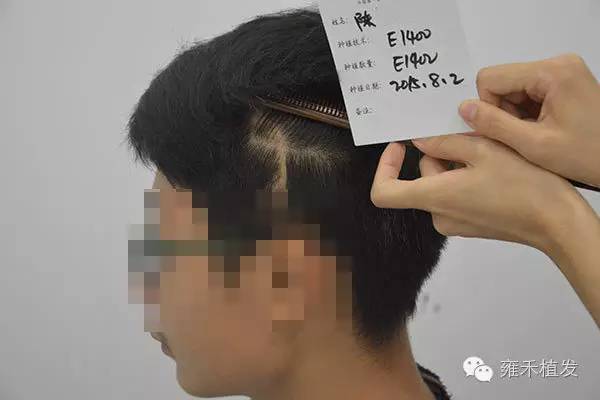 初中学生沈阳植发1407单位