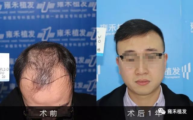 医生秃顶成都植发4483单位1年变帅医生