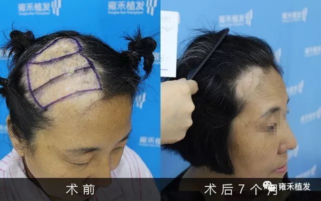 她头顶一块大疤痕植发3088单位半年后悔了