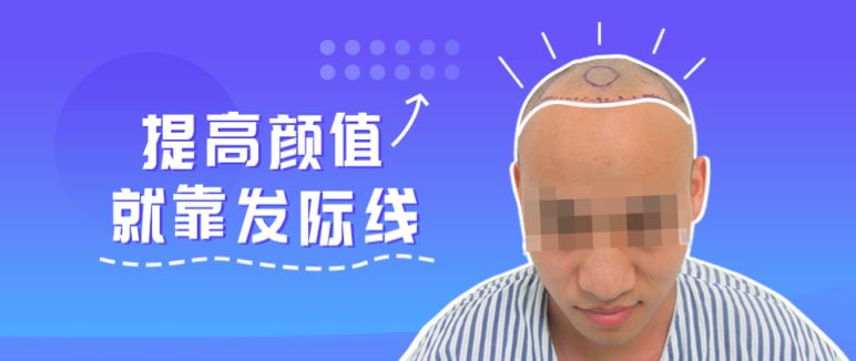 无痕2700单位种植发际线提升颜值和自信