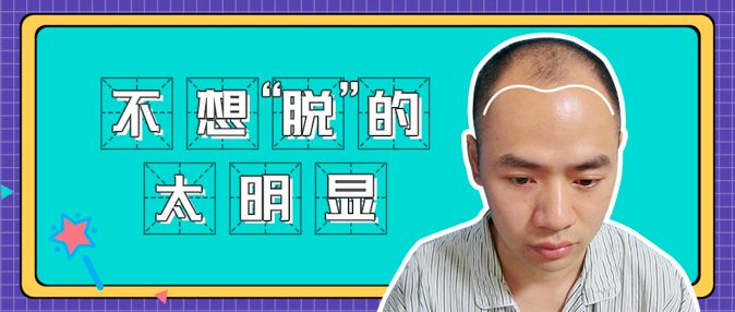 大面积脱发植发只种2500单位效果啥样
