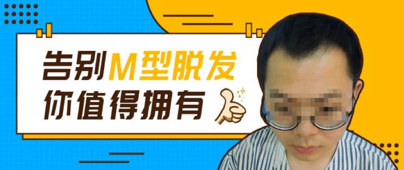 无痕植发1900毛囊单位告别年少脱发