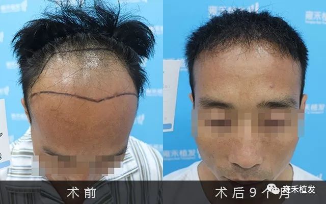 贵阳雍禾用FUE-APL2。0为韩先生植发种植3210单位