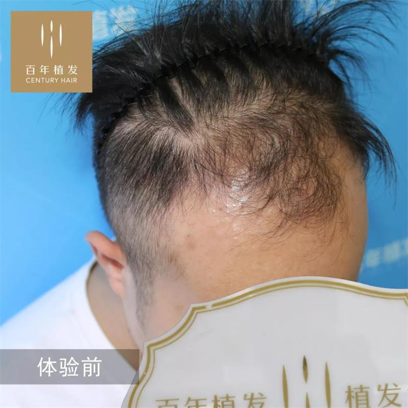 百年植发种植3000毛囊单位彻底告别油腻大叔