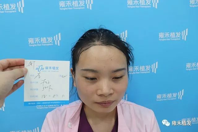 贵阳雍禾女护士也给自己植发500单位