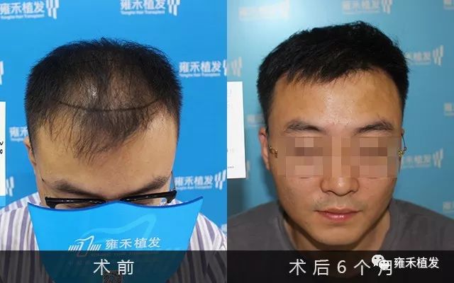 熬夜脱发严重植发3565单位半年就见效