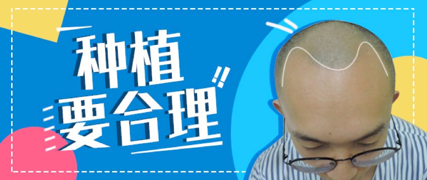 为啥不同的植发医院给出的毛囊移植数量有差异