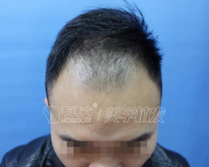 毛博士植发扔掉假发人生更自信