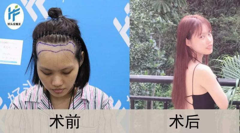 好头发潘潘植发2300单位守住发际线很重要！