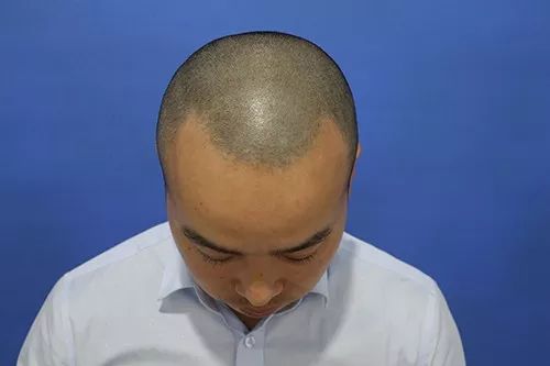 植发到底靠不靠谱？名韩植发发友真实案例告诉你！