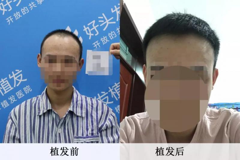 好头发植发后感觉人生到达了巅峰！