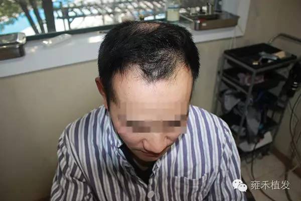 头旋脱发严重露头皮武汉雍禾植发2250单位
