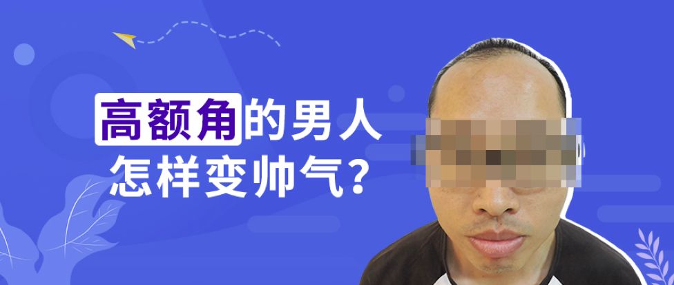 无痕植发2900毛囊单位自卑小哥蜕变为阳光型男