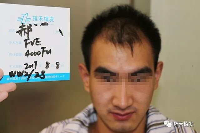 头顶稀疏严重植发4032单位7个月帅的明白