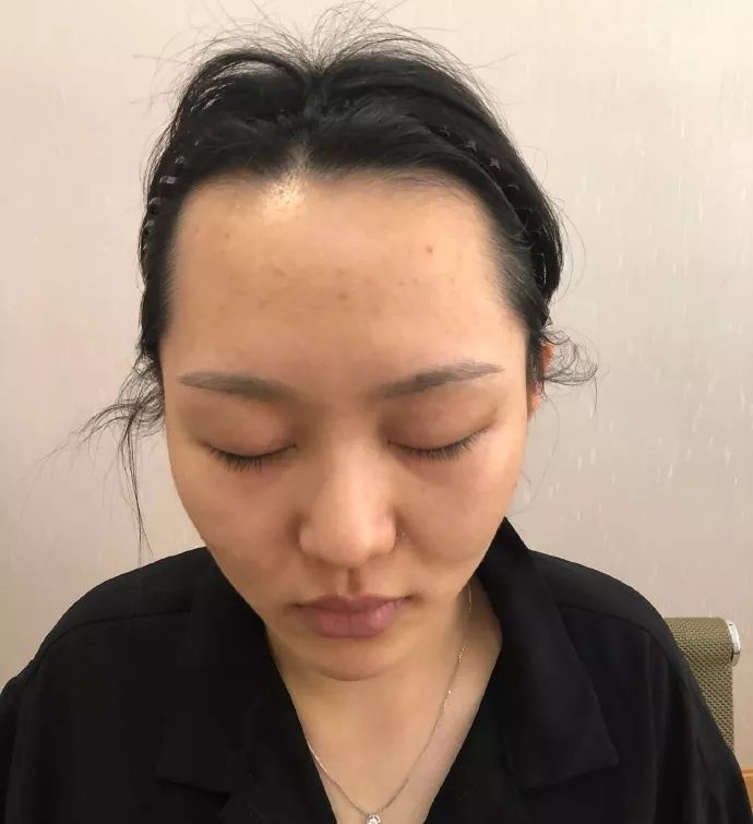 英国留学前植发准备迎接新生活！