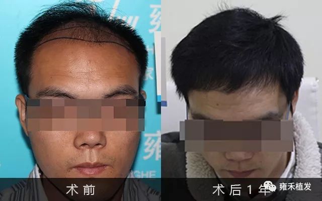 25岁就秃的没了样武汉植发2950单位变了样