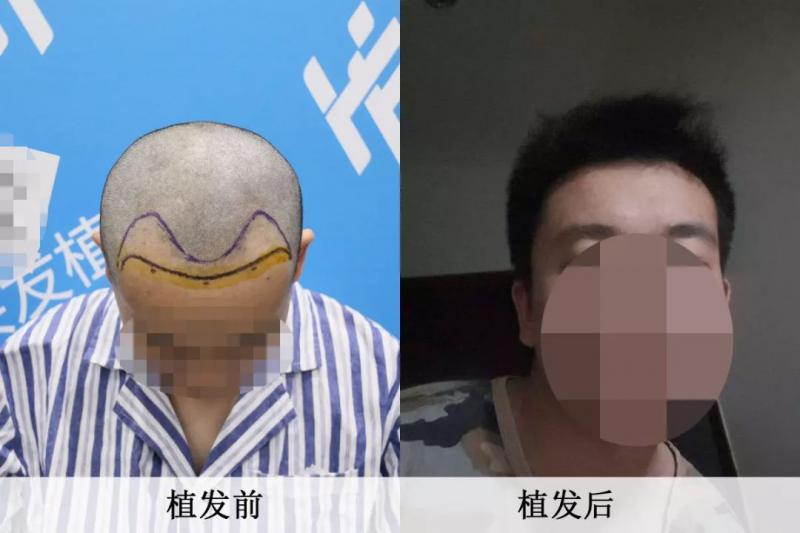 好头发植发2000单位总觉得还差点什么