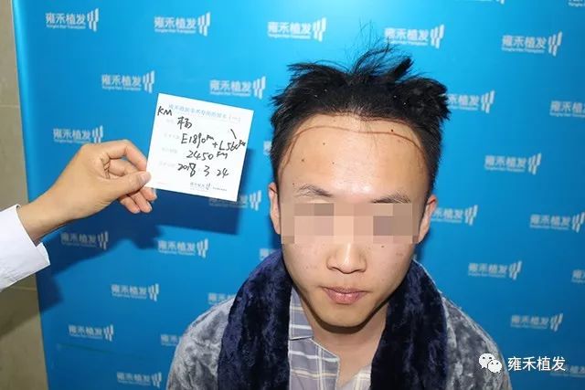 大四男生植发2455毛囊突然有了异性缘还要读研