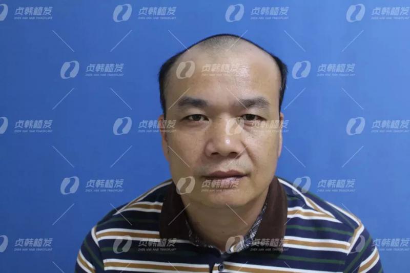 一个术前检查排除了南宁其他植发机构选了贞韩